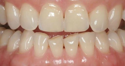 Patient 3 – Before teeth before dental services