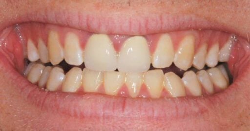 Teeth-2-Before Teeth-2-Before
